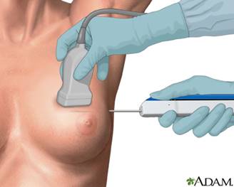 core needle biopsy