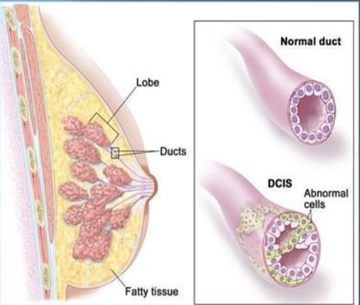 intraductal carcinoma